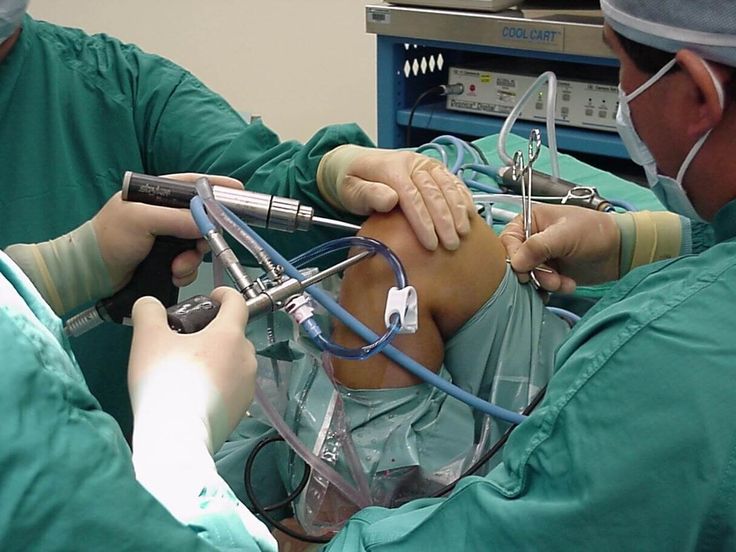 Arthroscopy Surgery